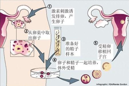 无精症